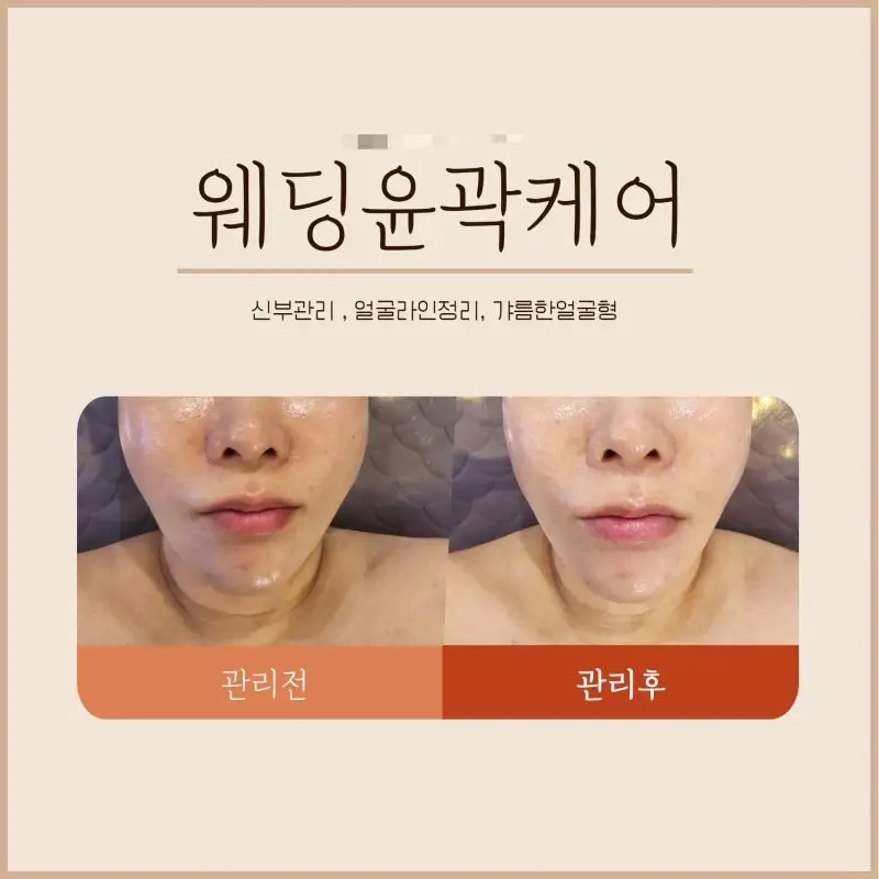 윤곽관리+테콜텍림프관리포함