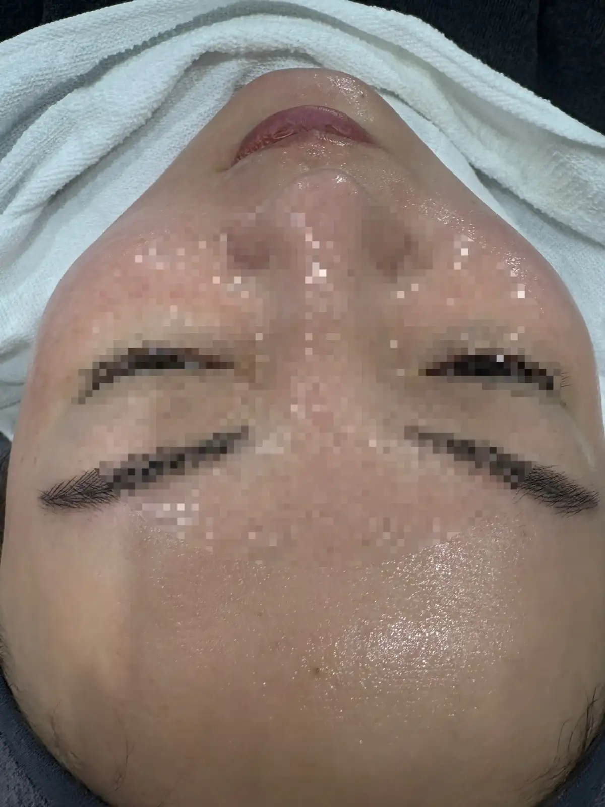 물광관리+데콜텍 포함