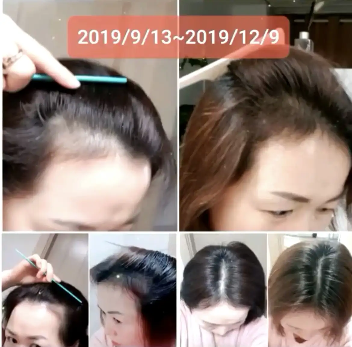 두피디톡스+탈모관리