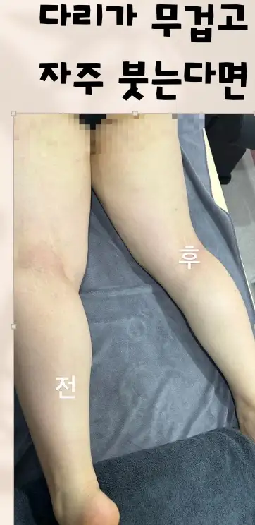 하체관리+림프순환관리+통증관리 포함