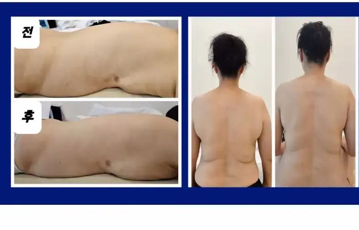 등+림프순환+통증관리 승모근포함