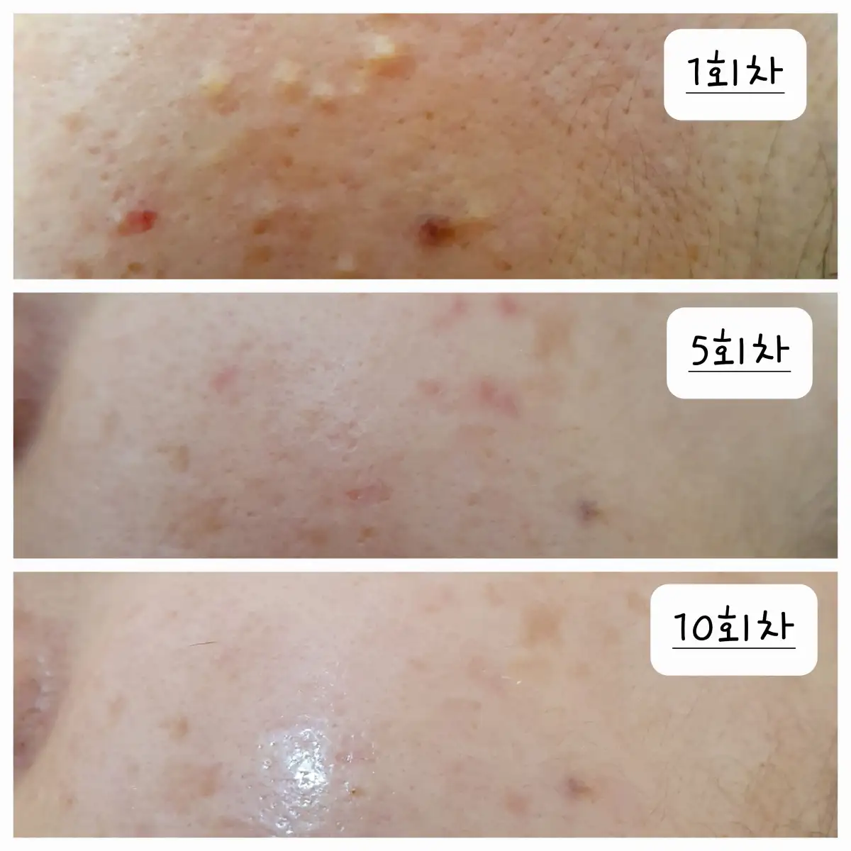 비립종 압출관리+림프순환 포함