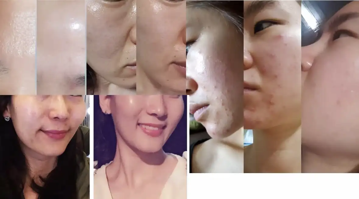 여드름케어+압출+림프관리 포함