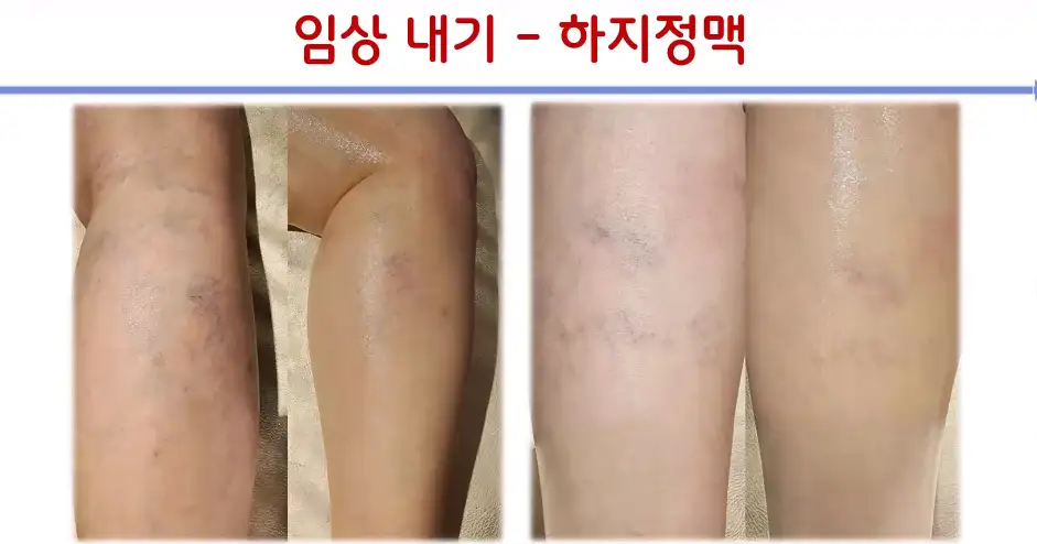 하지정맥류+림프순환 관리